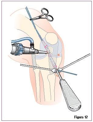 Fixação Tibial Após fixação do enxerto no túnel femoral, o joelho é colocado em flexão de 90 e a extremidade distal do enxerto é puxada firmemente para baixo no túnel tibial.