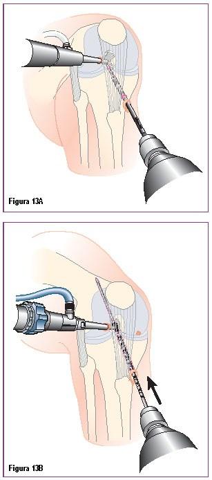 Abordagem Transtibial Utilizando Parafuso CALAXO Em adição à abordagem portal medial descrita previamente, uma abordagem tibial pode também ser utilizada para reconstrução do LCA utilizando o Sistema