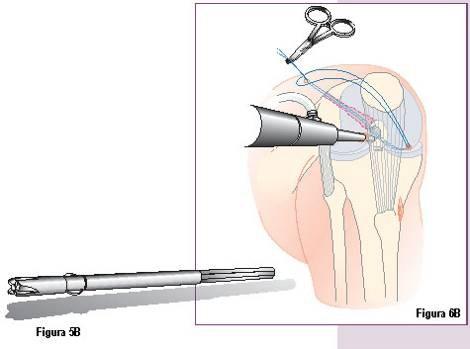extremidades livres da sutura através da coxa lateral (Figura 6A).