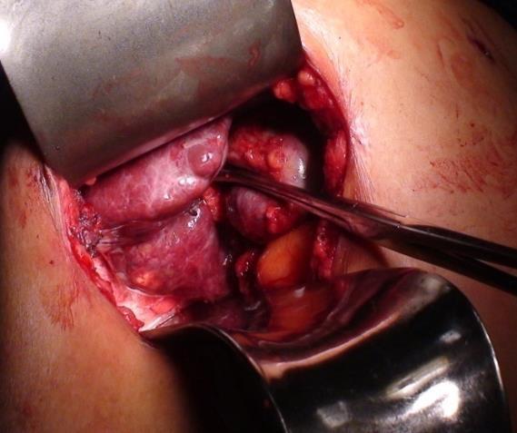 aprendizado Facilita compressão e hemostasia Sensação tátil Custo-efetiva: cirurgia mais econômica Sem a necessidade de