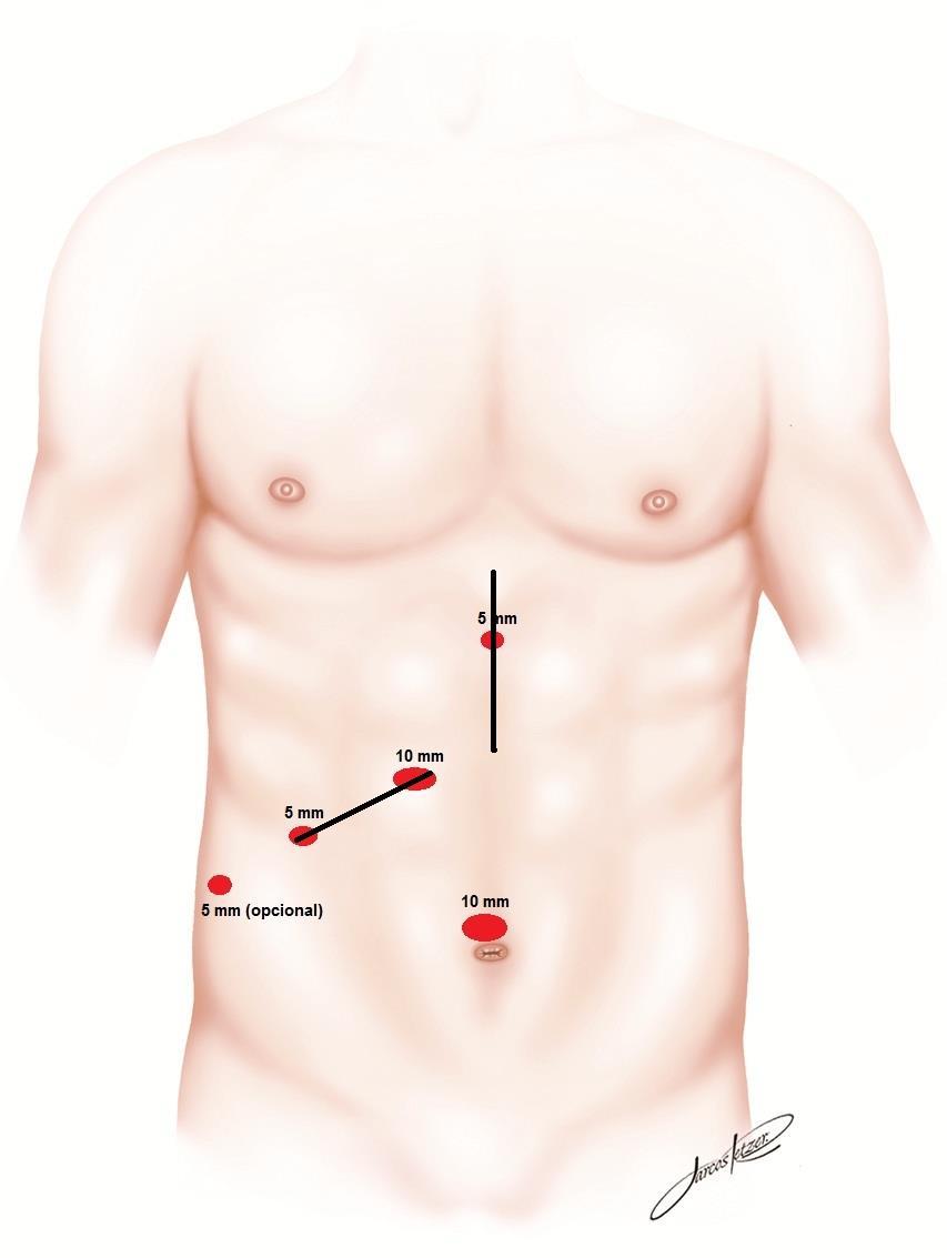 HEPATECTOMIA VIDEOASSISTIDA E COM