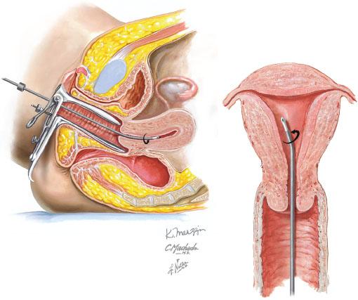 AVALIAÇÃO DIAGNÓSTICA Biópsia endometrial avaliação da presença de lesões neoplásicas (câncer/hiperplasia) avaliação