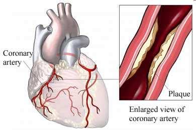 7 Coronárias Placa Artéria Coronariana Figura-1 Sistema arterial coronariano À direita, em destaque, representação esquemática mostrando estreitamento da artéria coronariana pela presença de placa