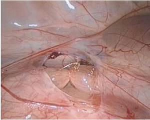 Lesão urológica Tratamento da lesão ureteral Se paciente estável a reparação deve ser durante a cirurgia Se paciente instável: aguardar estabilidade Opção de nefrostomia