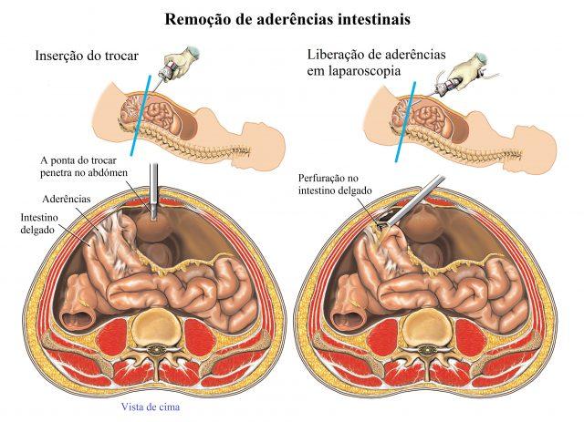 Lesão Intestinal Prevenção: Dissecção cuidadosa e seguindo plano