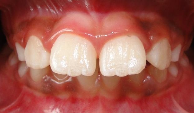 (ALMEIDA; ALMEIDA; ALMEIDA-PEDRIN, 2004) Além disso, tal condição pode comprometer a longevidade dos dentes e, por consequência, a saúde, por se tratar de um fator causal de doença periodontal e de