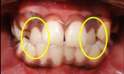 21 incisivos superiores oclui com a face lingual dos incisivos inferiores. Mordida cruzada posterior (MCP) quando o desvio da oclusão no sentido transverso incide sobre os dentes posteriores.