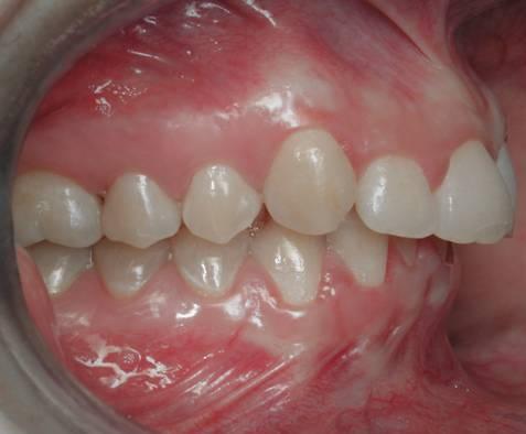 A cúspide mésiovestibular do primeiro molar superior oclui no espaço entre a cúspide vestibular do primeiro molar inferior e a face distal da