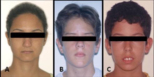 33 Figura 1 - Tipos faciais: A. Braquicefálico; B. Mesocefálico; C. Dolicocefálico Fonte: Curso de Especialização em Ortodontia da Faculdade de Odontologia da UFBA.