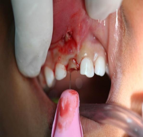 dente foi removido (Figura 7).