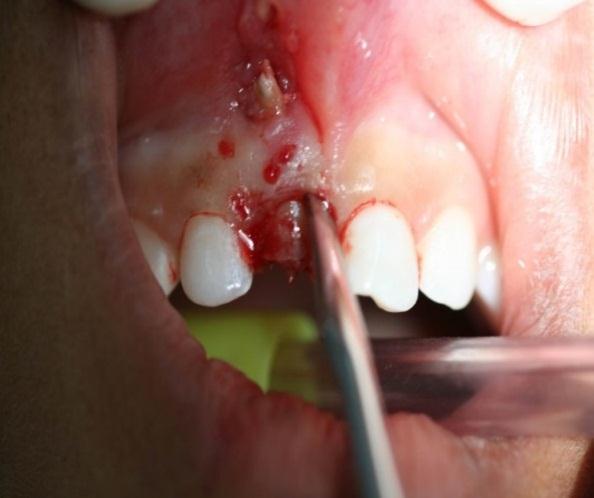 unidade permanente não apresentou indícios de alterações. Figura 2 - Radiografia periapical da unidade 51.