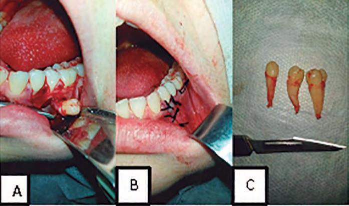 quadrante Figura 9 Presença de infecção constatada clínica (A) e radiograficamente (B) Figura 6