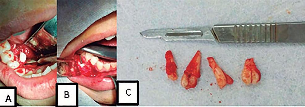 infectada onde foi encontrado um ponto remanescente da sutura (A), pós-operatório imediato (B) e sete
