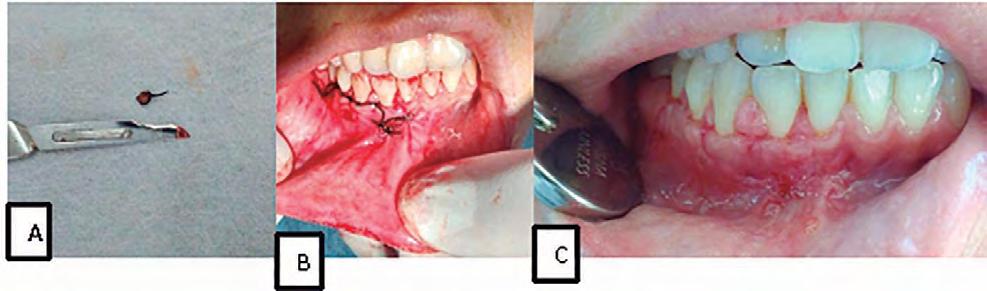 No mesmo estudo, também foi verificado que todos os pacientes afetados por múltiplos dentes