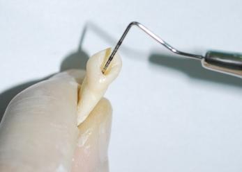 Para a realização do selamento coronário, foram removidos 4 milímetros do material obturador abaixo da embocadura do canal radicular por meio