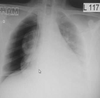 Revisão de Literatura 24 A B Figura 7- Radiografias de paciente com expansão pulmonar incompleta. A: Derrame pleural volumoso à direita.
