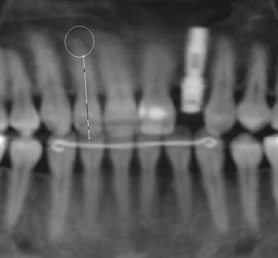 72 Material e Métodos correspondendo ao longo eixo dentário, que passava pelo maior numero de pontos no centro do canal radicular e seguia em direção incisal (Fig. 4.