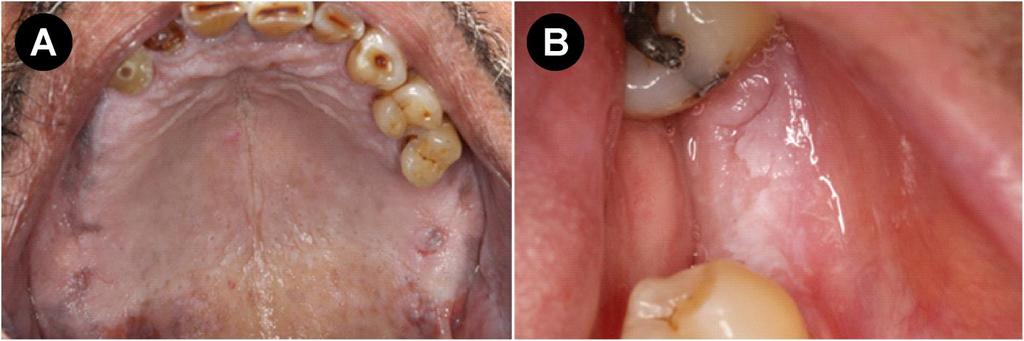 22 Figura 2 Imagens clínicas de dois casos em que houve revisão de diagnóstico: estomatite nicotínica em palato duro e mole (A).