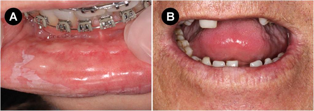 Figura 3 Imagens clínicas de dois casos em que houve revisão de diagnóstico: líquen plano apresentando-se como placa em lábio inferior de paciente no qual também foram identificadas lesões estriadas