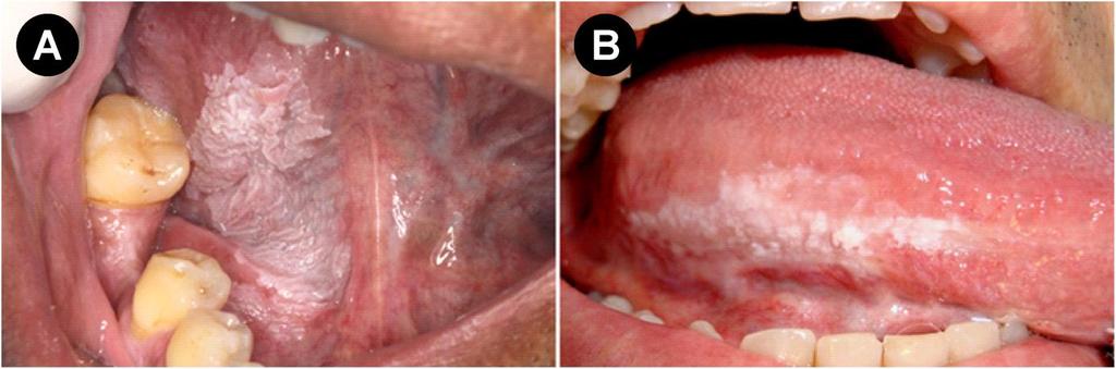 23 Figura 4 Imagens clínicas do paciente #1, no qual detectou-se leucoplasia não homogênea na mucosa do assoalho bucal e no ventre de língua com diagnóstico histopatológico de acantose e