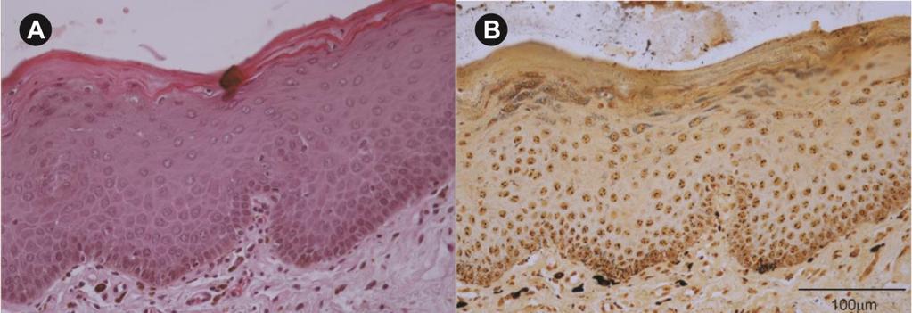 27 Figura 7 Fotomicrografias de espécime obtido a partir de biópsia de leucoplasia homogênea displásica localizada em mucosa de palato mole do paciente #12.