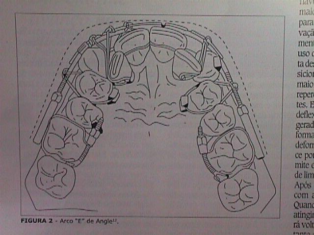 1 Angle Arco E Um arco preso às bandas nos molares.