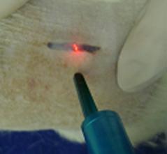 30 Figura 1: Procedimento cirúrgico com laser de CO 2 (LOUZADA, 2008)