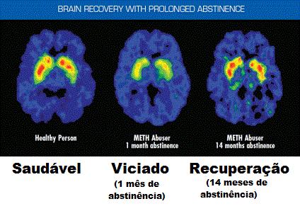 Cérebro em recuperação