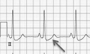Hipocalemia grave (K < 2,0 m Eq/L) pode ser devida: Rabdomiólise Íleo paralítico Poliúria (dano tubular) Distúrbios do ritmo cardíaco.