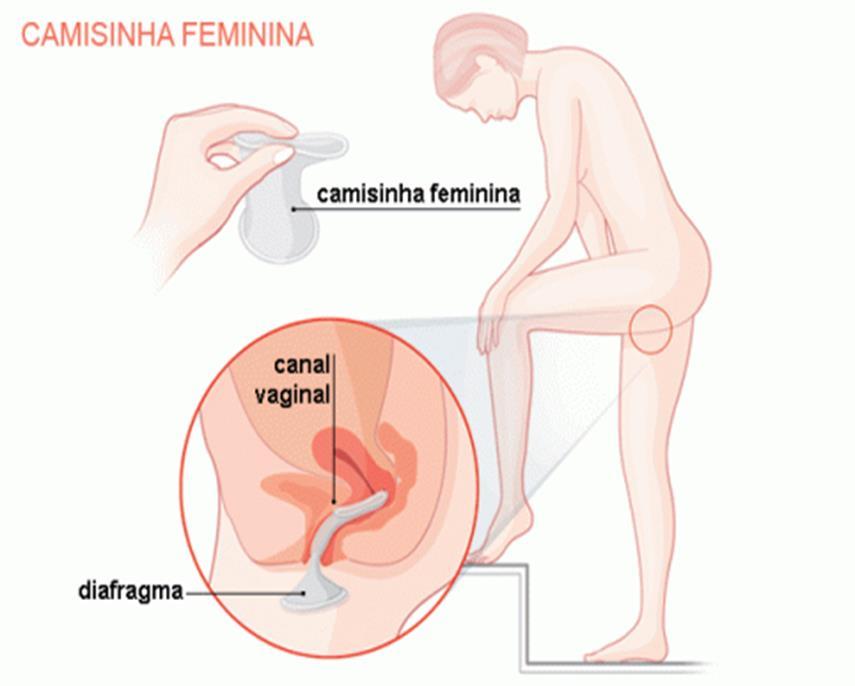 Funciona como uma barreira, recebendo o esperma ejaculado pelo homem na relação sexual, impedindo a entrada dos espermatozoides no corpo da mulher.
