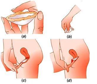 O diafragma é um anel flexível envolvido por uma borracha fina, que impede a entrada dos espermatozoides no útero.