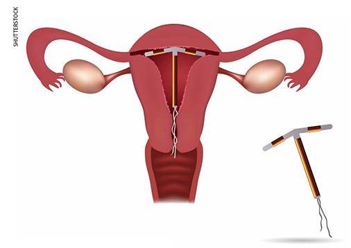 Existem diversos modelos de DIU. O mais usado é o T de cobre. A fertilidade da mulher, ou seja, a sua capacidade de engravidar, retorna logo após a retirada do DIU.