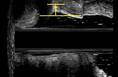 1 Anorretocele grau I Cinedefecografia - As seis pacientes com anorretocele grau I apresentaram discreta distensão da parede posterior da vagina durante esforço evacuatório com distância