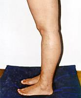 GENOFLEXO Apresenta uma flexão da articulação do joelho, ou seja, ocorre uma limitação da extensão completa