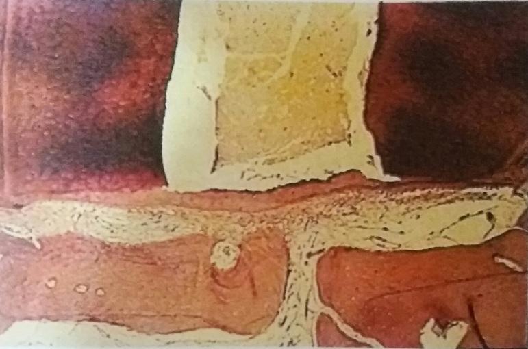 28 Figura 7 - Retrobturação em dente de cão feita com MTA. Presença de cemento depositada sobre a dentina apicectomizada e sobre o material, com bom selamento apical Fonte: Bernabé & Holland.