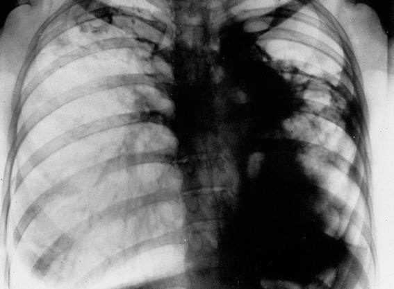 Doenças do sistema respiratório As doenças do sistema respiratório têm grande impacto no