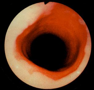 4 centímetros - a regra dos três centímetros - além da confirmação histológica de metaplasia intestinal (21).