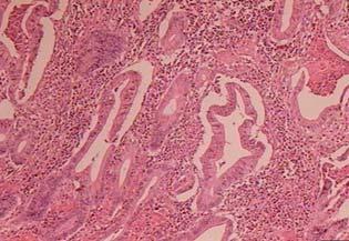 imunohistochemical expressions of c-myc (D,E, F).