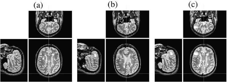 Alinhamento de estruturas em imagens médicas Conceitos (III) Exemplo: (a) Imagens de ressonância magnética de um paciente