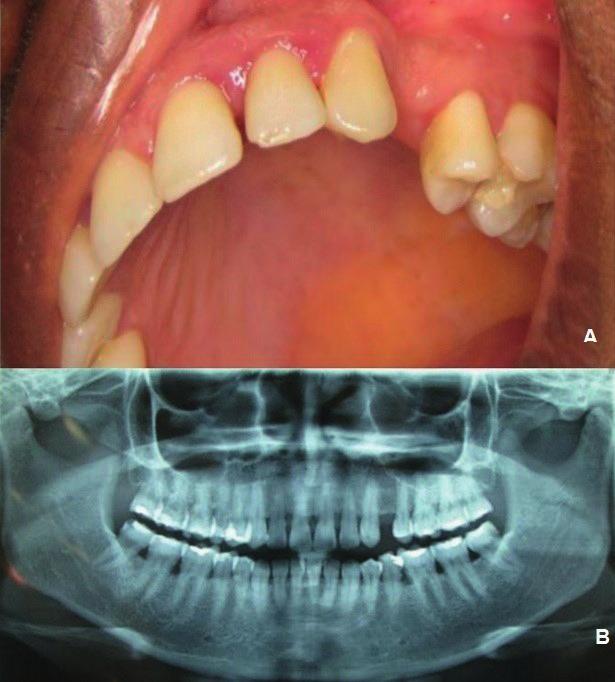 INTRODUÇÃO A reabilitação oral através da implantodontia tem-se tornado escolha frequente de tratamento dos cirurgiões-dentistas a pacientes desdentados total ou parcialmente que necessitam