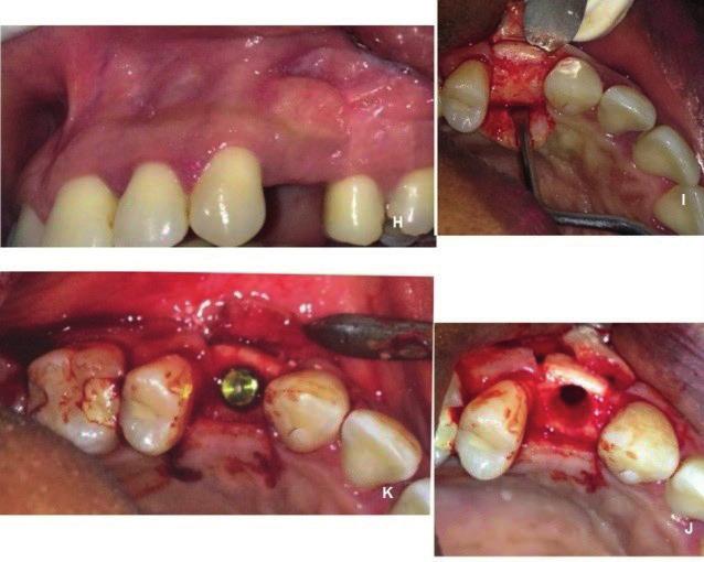 I- Osseointegração do enxerto com a área receptora. J- Perfuração para instalação de implante. K- Implante instalado.
