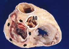 Correlação Ana omoclínica Arq Bras Cardiol valva mitral. Foi indicado tratamento cirúrgico baseado nos sintomas incapacitantes e na presença de disfunção ventricular 1.
