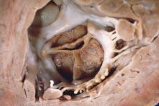 Correlação Ana omoclínica Fig. 4 - Vista ventricular da prótese mitral, que exibe espessamento e aposição superficial de material esbranquiçado e friável.