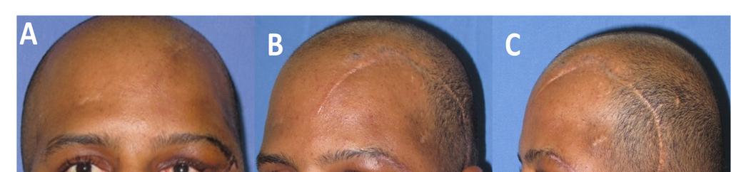 Figuras 6. A, B e C - Aspecto clínico no 15º dia pós-operatório da segunda cirurgia evidenciando levantamento da pálpebra superior e do canto externo do olho esquerdo.