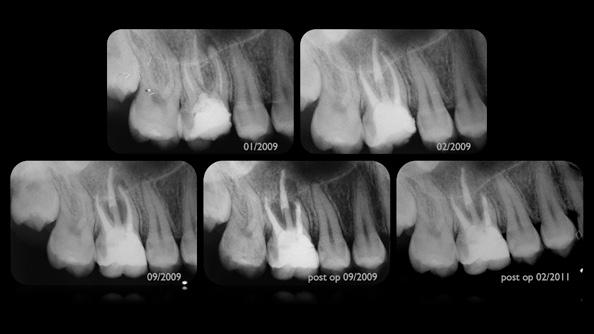Mecanismo de Ação eação do Tecido Conjuntivo de ato ao Implante de Tubos de Dentina Preenchidos com MTA Angelus (Holland et al., 2001).