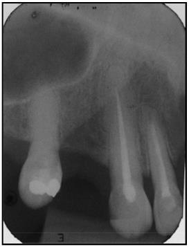 Paciente 4 - RAR, dente