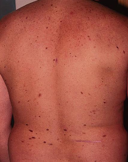 clinicamente atípicos e com características histológicas distintas. Pessoas com essa síndrome têm um risco mais de 150 vezes maior de desenvolver melanoma em relação à população em geral.