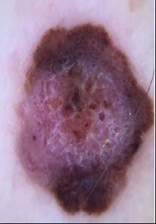 19 dos melanomas diagnosticados em estágio precoce é potencialmente curável.
