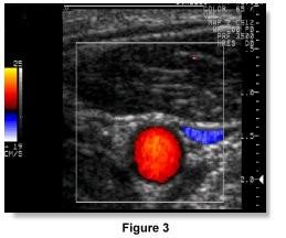 Ondas Sonoras A medição do desvio de frequência do sinal reflectido permite medir a Velocidade do sangue nas ecografias Doppler: Sangue a mover se na