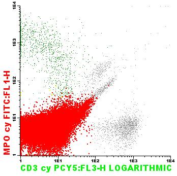 Dendríticas Plasmocíticas Infiltração de MO por tumores